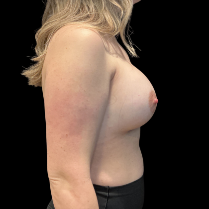 Breast Augmentation Before & After Patient #13669