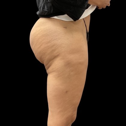 Fat Transfer Before & After Patient #13670