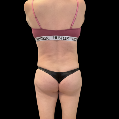 Rib Repositioning Before & After Patient #13675