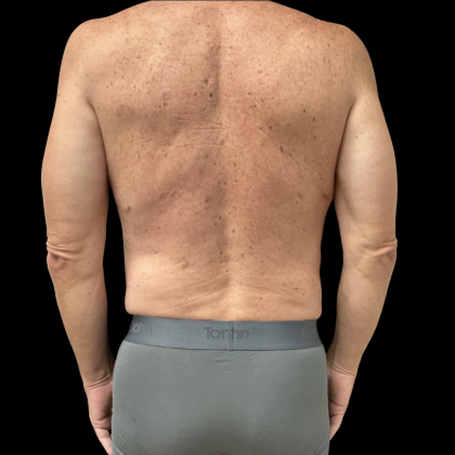 Liposuction Before & After Patient #13685