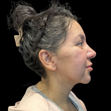 MyEllevate Before & After Patient #13624