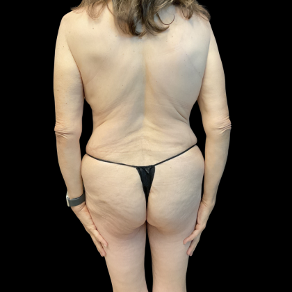 Tummy Tuck Before & After Patient #13682