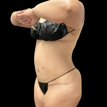 Brazilian Butt Lift Before & After Patient #13626