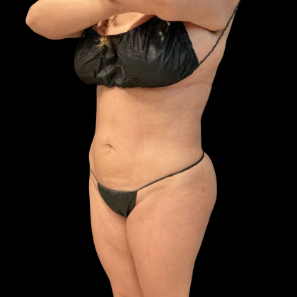 Brazilian Butt Lift Before & After Patient #13588
