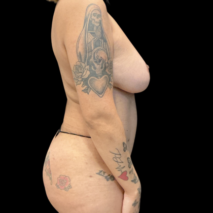 Mastopexy augmentation Before & After Patient #13657
