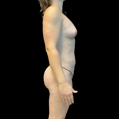 Fat Transfer Before & After Patient #13661