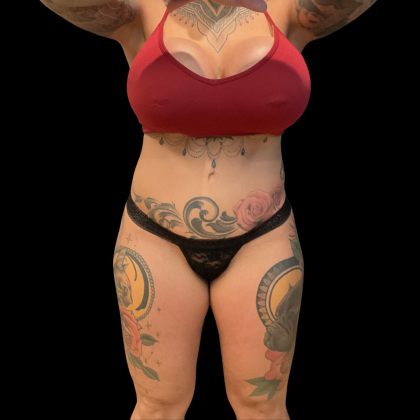 Butt Implants Before & After Patient #13659
