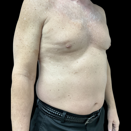 Liposuction Before & After Patient #13685