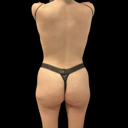 Brazilian Butt Lift Before & After Patient #14199