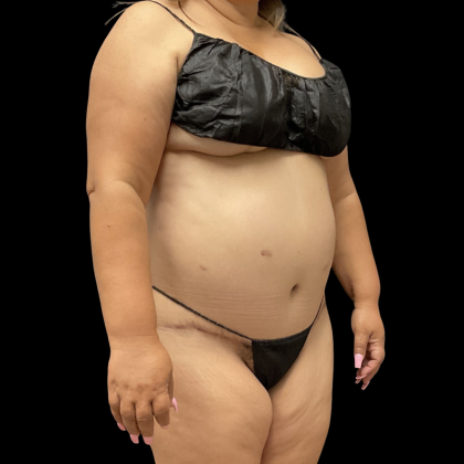 Brazilian Butt Lift Before & After Patient #13626
