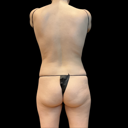 High Definition Liposuction Before & After Patient #13667