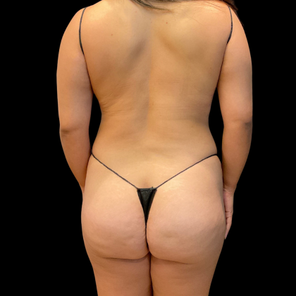 Tummy Tuck Before & After Patient #13666