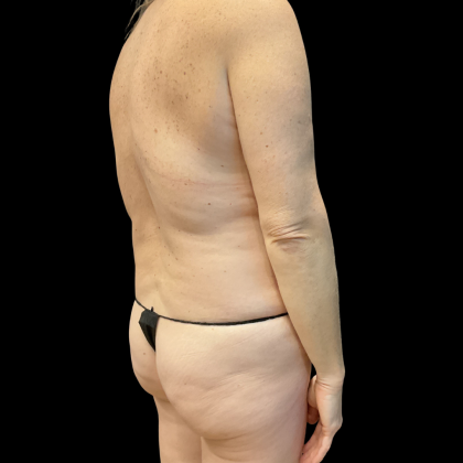 Tummy Tuck Before & After Patient #13672