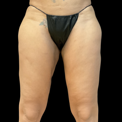 Fat Transfer Before & After Patient #13670