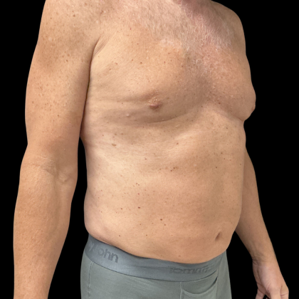 Liposuction Before & After Patient #13685
