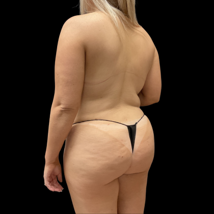 Tummy Tuck Before & After Patient #13686