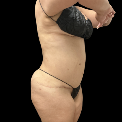 Brazilian Butt Lift Before & After Patient #13626