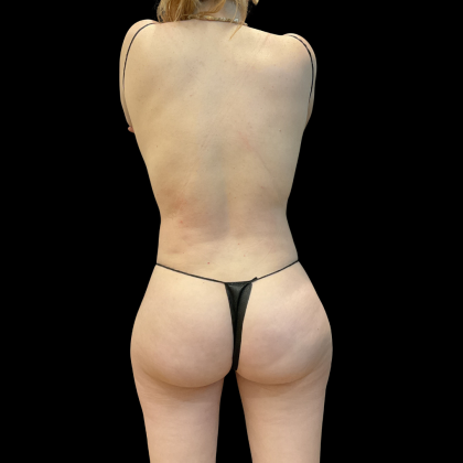 High Definition Liposuction Before & After Patient #13667