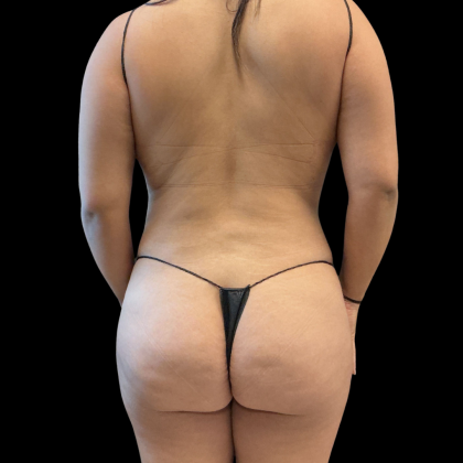 Tummy Tuck Before & After Patient #13666
