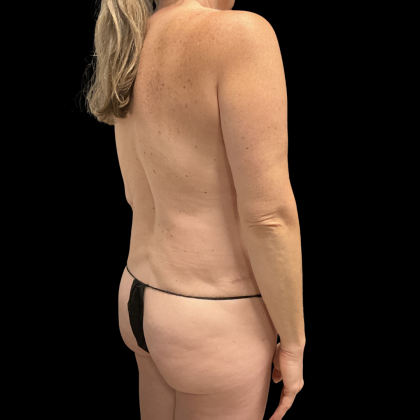 Tummy Tuck Before & After Patient #13672