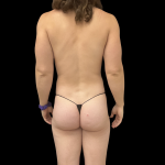 Fat Transfer Before & After Patient #13661