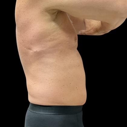 Liposuction Before & After Patient #13685