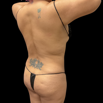 Liposuction Before & After Patient #13684