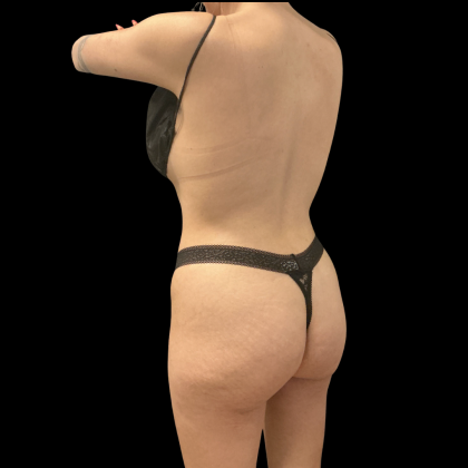 Brazilian Butt Lift Before & After Patient #14199