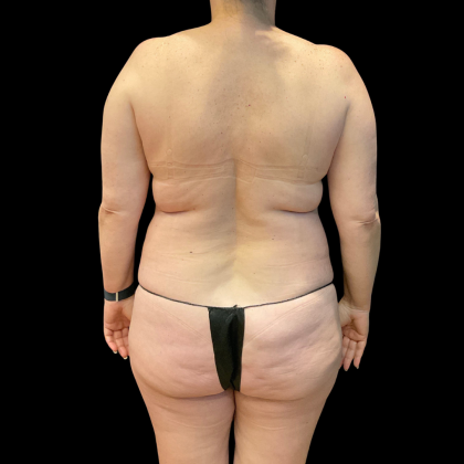 Tummy Tuck Before & After Patient #13664