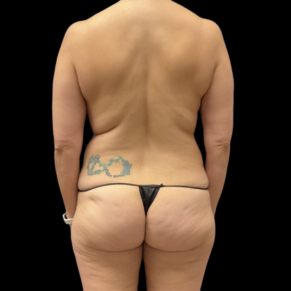 Mommy Makeover Before & After Patient #13665
