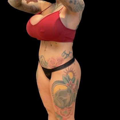 Butt Implants Before & After Patient #13659