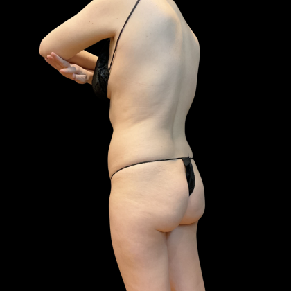 High Definition Liposuction Before & After Patient #13667