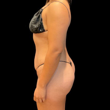 Tummy Tuck Before & After Patient #13666