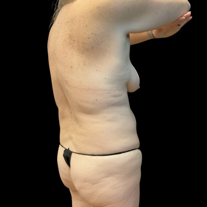 Tummy Tuck Before & After Patient #13672