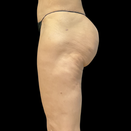 Fat Transfer Before & After Patient #13670