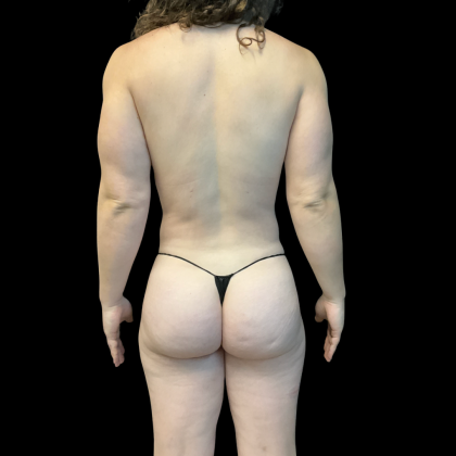 Fat Transfer Before & After Patient #13661