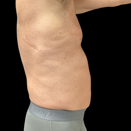 Liposuction Before & After Patient #13685