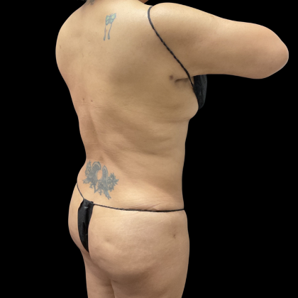 Liposuction Before & After Patient #13684