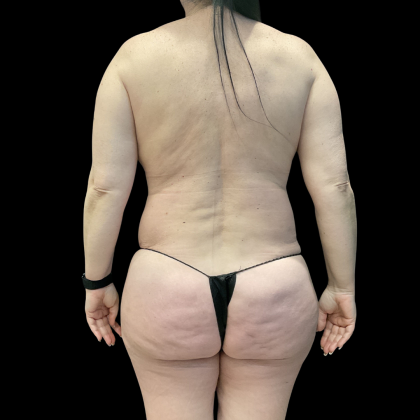 Tummy Tuck Before & After Patient #13664