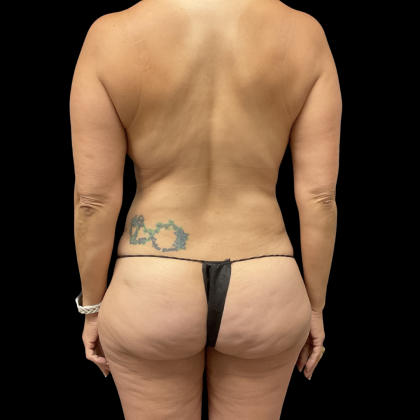 Mommy Makeover Before & After Patient #13665