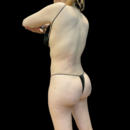 High Definition Liposuction Before & After Patient #13667