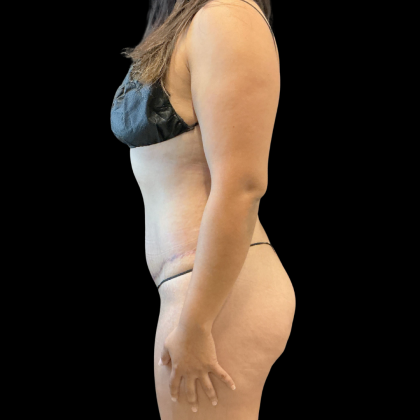 Tummy Tuck Before & After Patient #13666