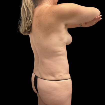 Tummy Tuck Before & After Patient #13672