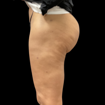 Fat Transfer Before & After Patient #13670