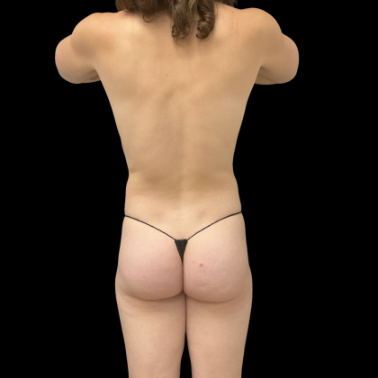 Fat Transfer Before & After Patient #13661