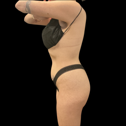 Brazilian Butt Lift Before & After Patient #14199
