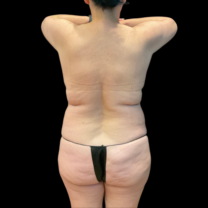 Tummy Tuck Before & After Patient #13664