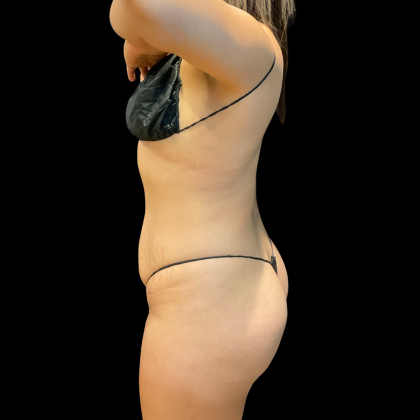Tummy Tuck Before & After Patient #13666