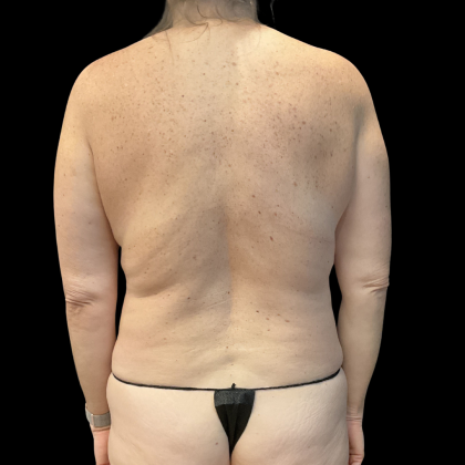 Tummy Tuck Before & After Patient #13672