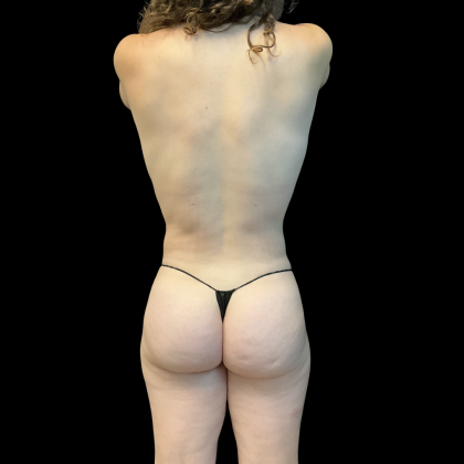 Fat Transfer Before & After Patient #13661